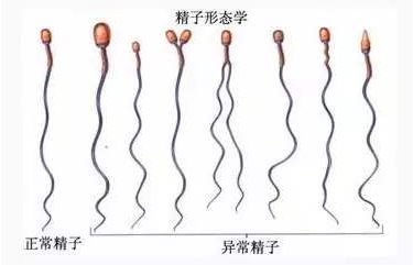 盐城怎样检查精子是否畸形